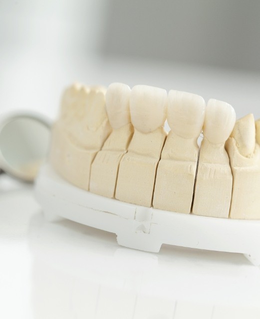 Model smile with dental crown supported fixed bridge restoration