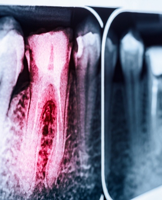 X-ray of root canal treated tooth