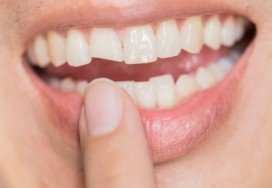 Closeup of smile with chipped front tooth