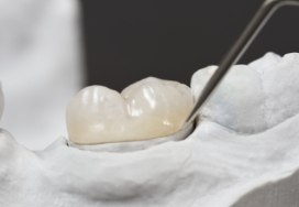 Model smile used to replace lost dental crown
