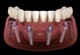 Animated dental implant supported denture placement