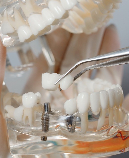 Model smile with dental implant supported fixed bridge