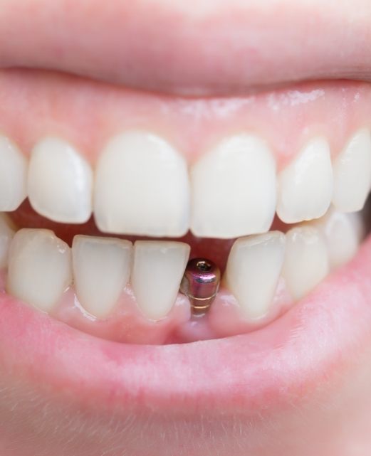 Smile with dental implant post visible