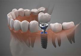 Diagram of a dental implant inside the jaw