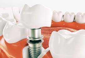 Diagram highlighting components of dental implants in Spring Lake