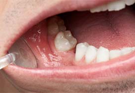 Closeup of a person with tooth loss in Spring Lake