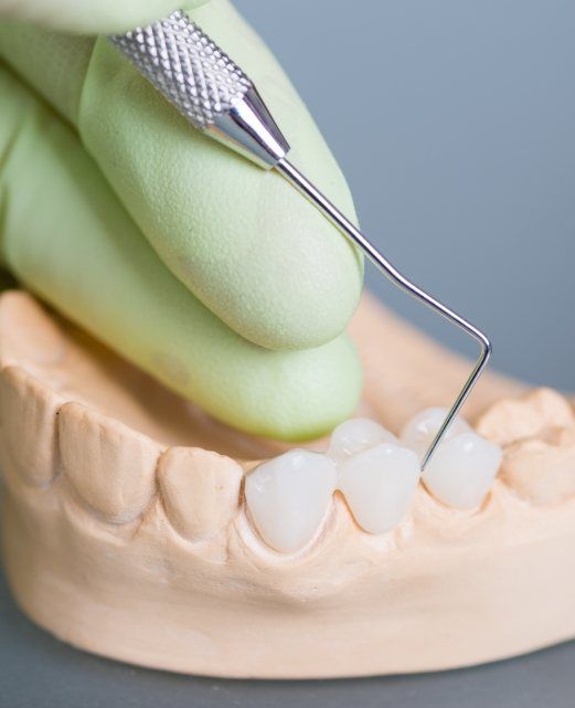 Model smile with dental bridge restoration