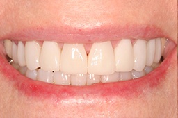 Smile after periodontal disase treatment