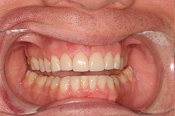 Flawlessly renewed smile after restorative dentistry