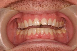Severely worn damaged smile before restorative dentistry