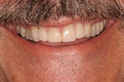 Healthy, perfectly aligned smile after cosmetic dentistry
