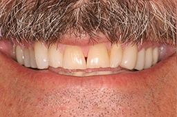 Damaged and unevely spaced top teeth before cosmetic dentistry
