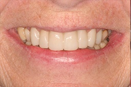 Healthy gorgeous smile after smile makeover