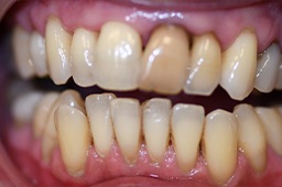 Severely worn and decayed smile before smile makeover