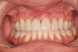Healthy smile after dental implant tooth replacement