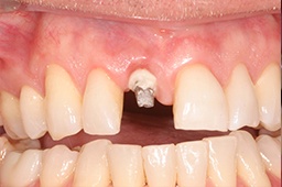 Missing tooth with dental implant post visible in gums