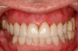 Healthy teeth and gums after smile makeover