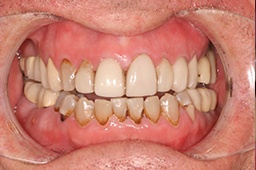 Decayed teeth and receding gums before smile makeover