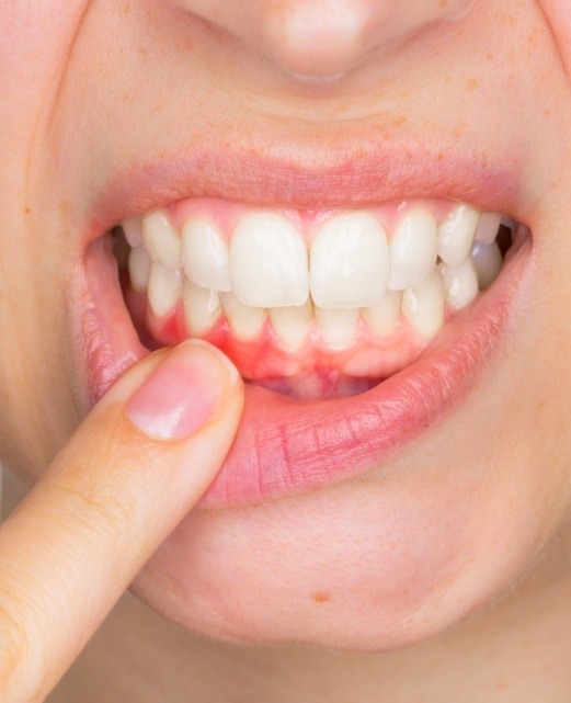 Closeup of smile with inflamed gums before gum disease treatment