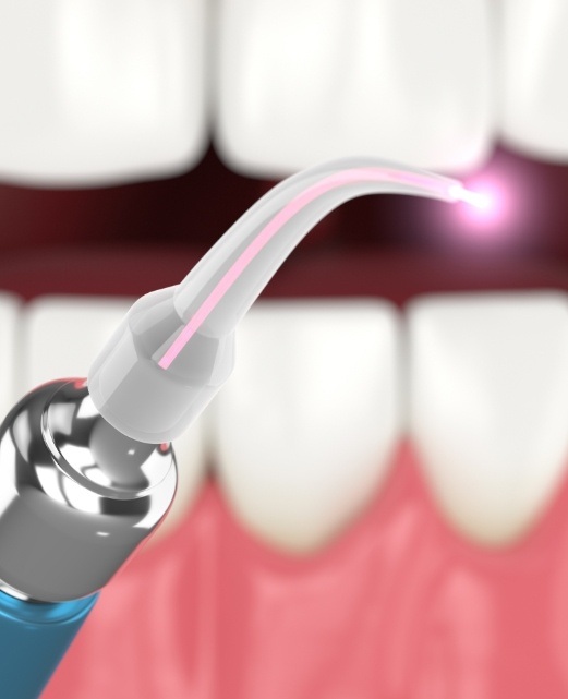 Animated smile and laser periodontal therapy tool