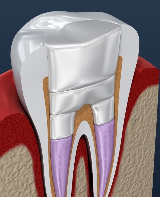 Animated tooth after root canal therapy