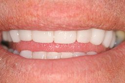 Healthy aligned smile after clear braces