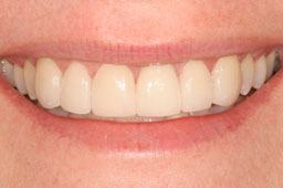 Beautiful smile after cosmetic dentistry