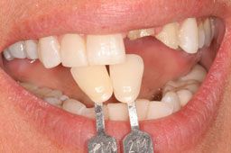 Severely damaged top teeth before dental crown restoration