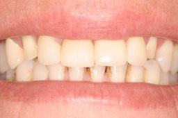 Discolored and unhealthy teeth before dental restoration