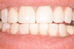 Aligned bottom row of teeth after orthodontics