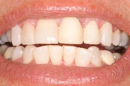 Crooked bottom row of teeth before orthodontics