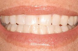 Evenly spaced teeth after orthodontic treatment