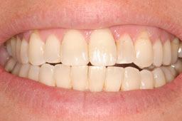 Healthy restored top front teeth