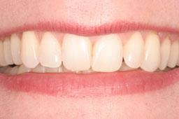 Aligned smile after clear braces
