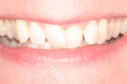Misaligned smile before clear braces