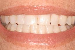Gap between teeth closed after clear braces