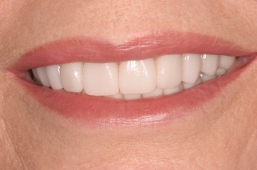 Closeup of M G's smile after treatment