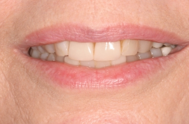 Closeup of M G's smile before treatment