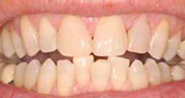 J V's smile before dental treatment
