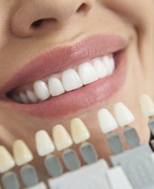 Woman's smile compared with porcelain veneer shade chart