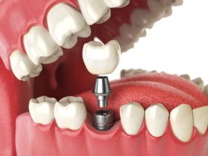 a computer illustration showing how a dental implant is able to replace a missing tooth