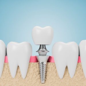3D illustration of dental implants