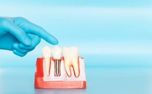 anatomy of healthy teeth and dental implant 