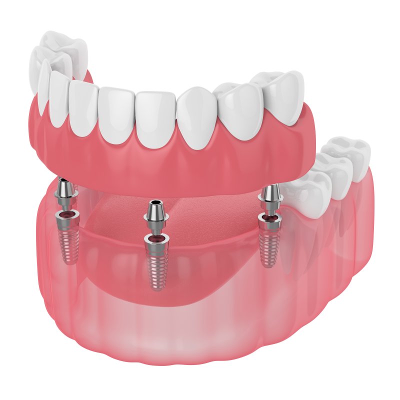 Dental implant-retained denture