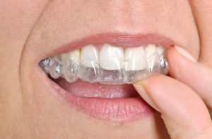 woman inserting invisalign tray