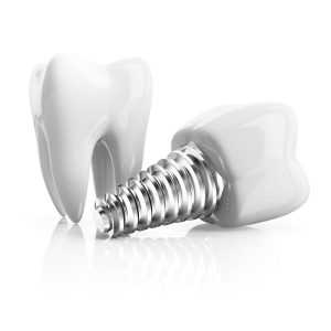 Replace your missing teeth with dental implants in Wall Township.