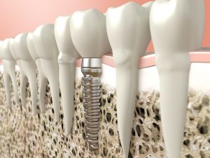 representation of dental implants