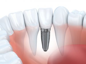 Single tooth dental implant surrounded by natural teeth